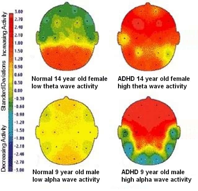 Causes of ADHD. sEG Scan with ADHD individual showing the difference btween a normal and adhd brain